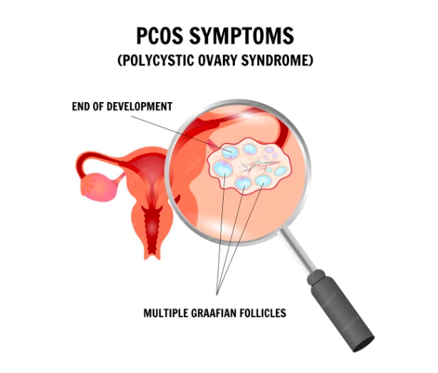 PCOS Kya Hai in Hindi: लक्षण, कारण और उपाय 1 PCOS Kya Hai in Hindi