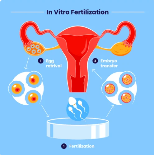 Is Bed Rest After Embryo Transfer Needed?