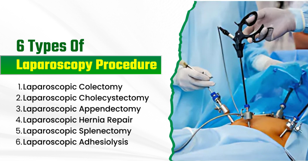 Laparoscopy