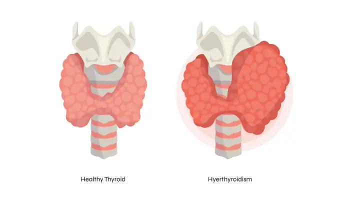 what is thyroid ?