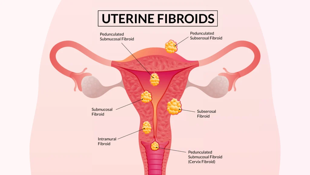 फाइब्रॉइड के प्रकार (Types of Fibroids)