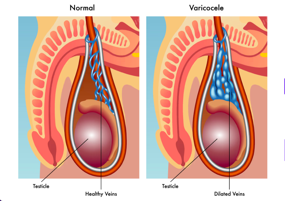  Varicocele Meaning in Hindi